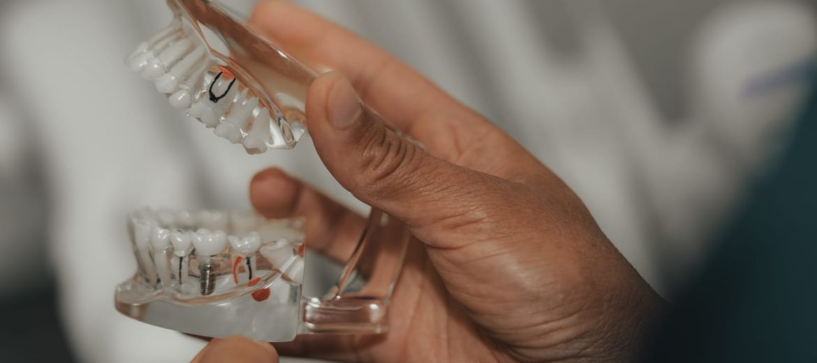 Dental Implants