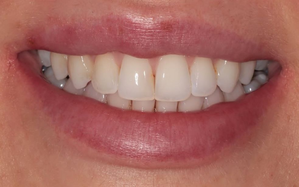 Close-up of a natural, straight smile after clear aligner treatment