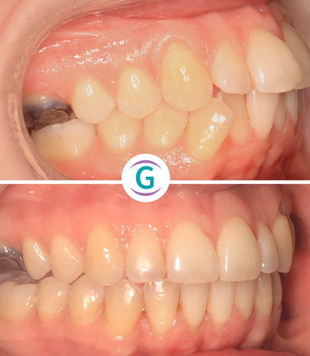 Glendair Dental Straight Teeth