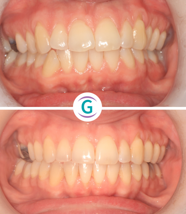 Glendair Dental Straight Teeth