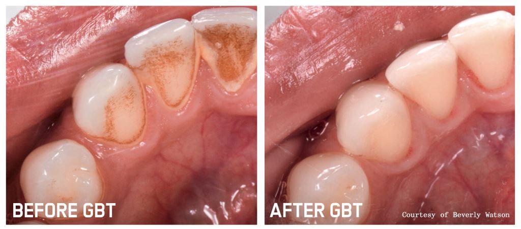 Glendair Dental Guided Biofilm Therapy