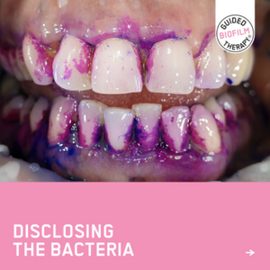Glendair Dental Guided Biofilm Therapy