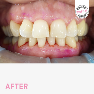 Glendair Dental Guided Biofilm Therapy