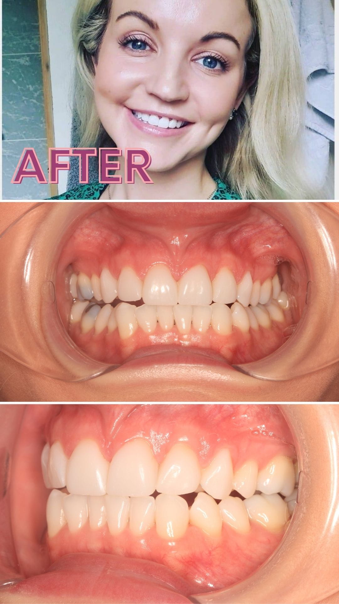 smile makeover treatment