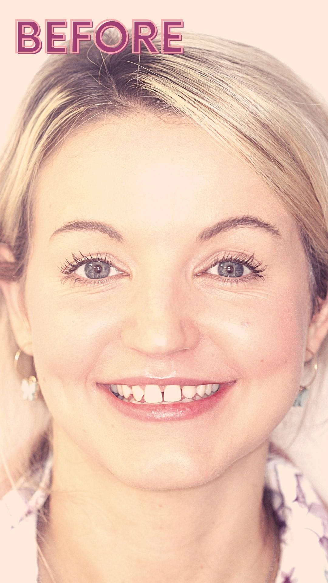 smile makeover treatment