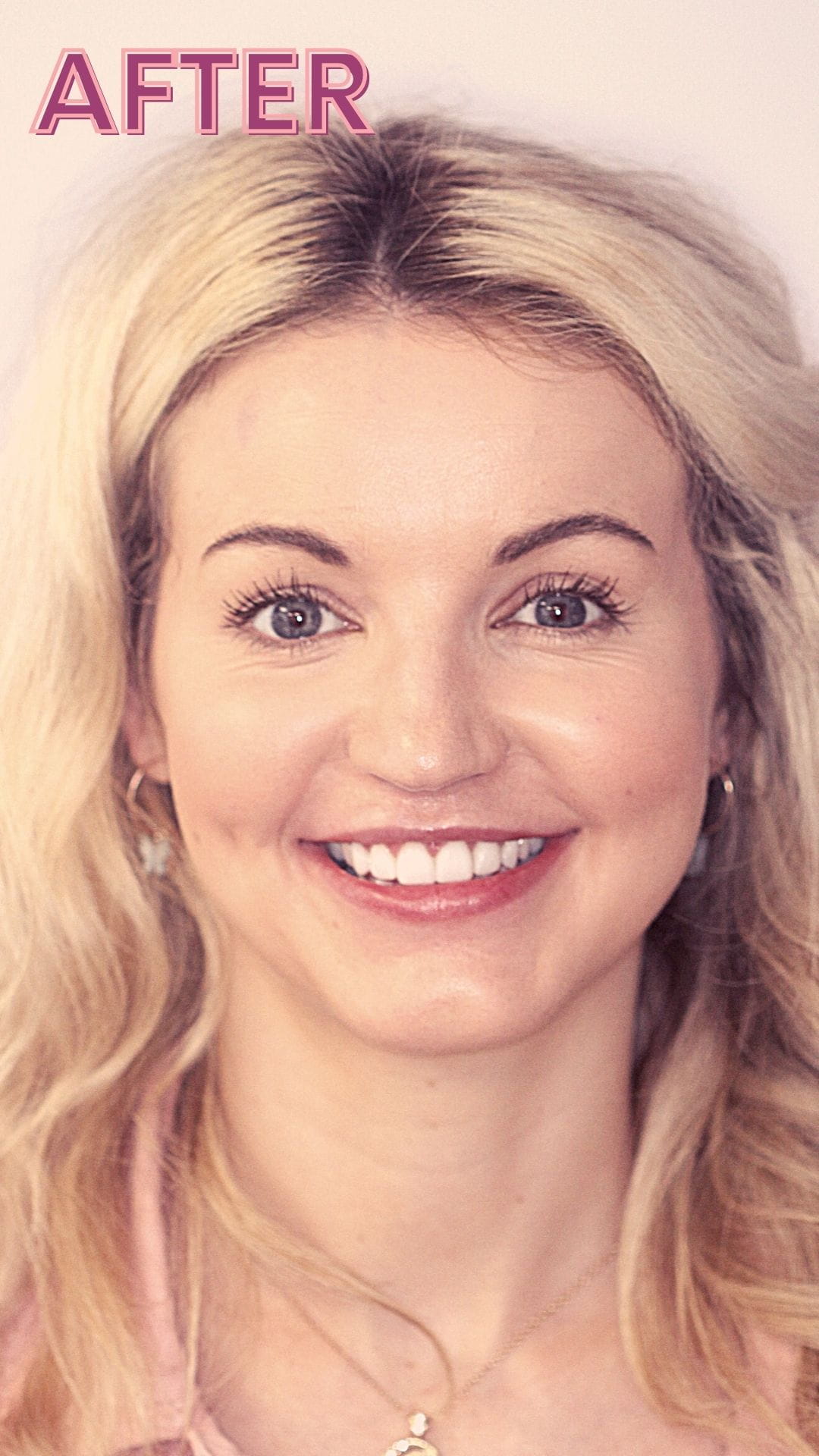 smile makeover treatment