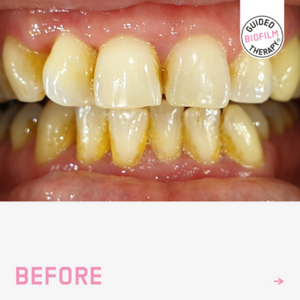 Glendair Dental Guided Biofilm Therapy