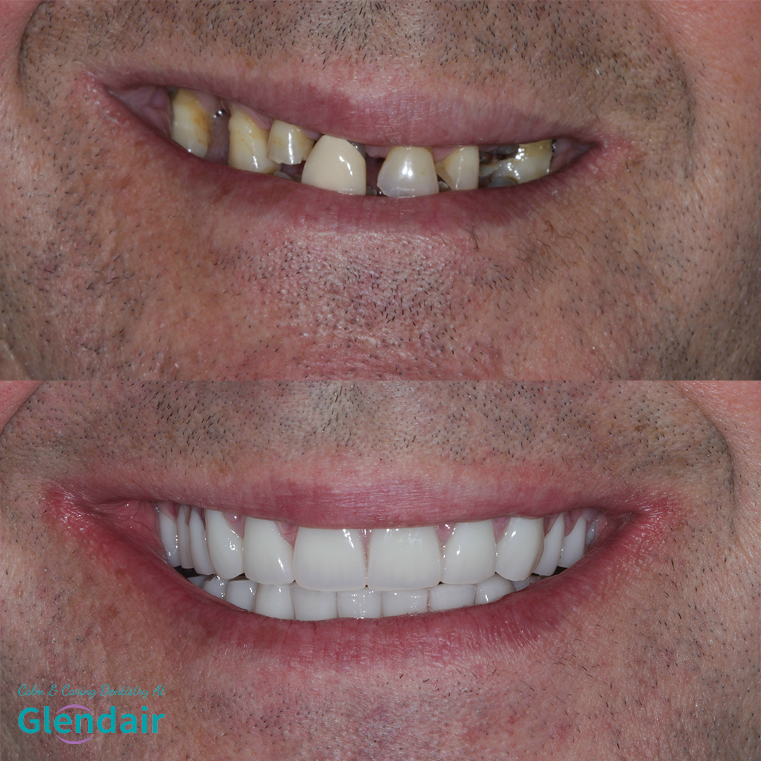 All On 4 Dental Implants