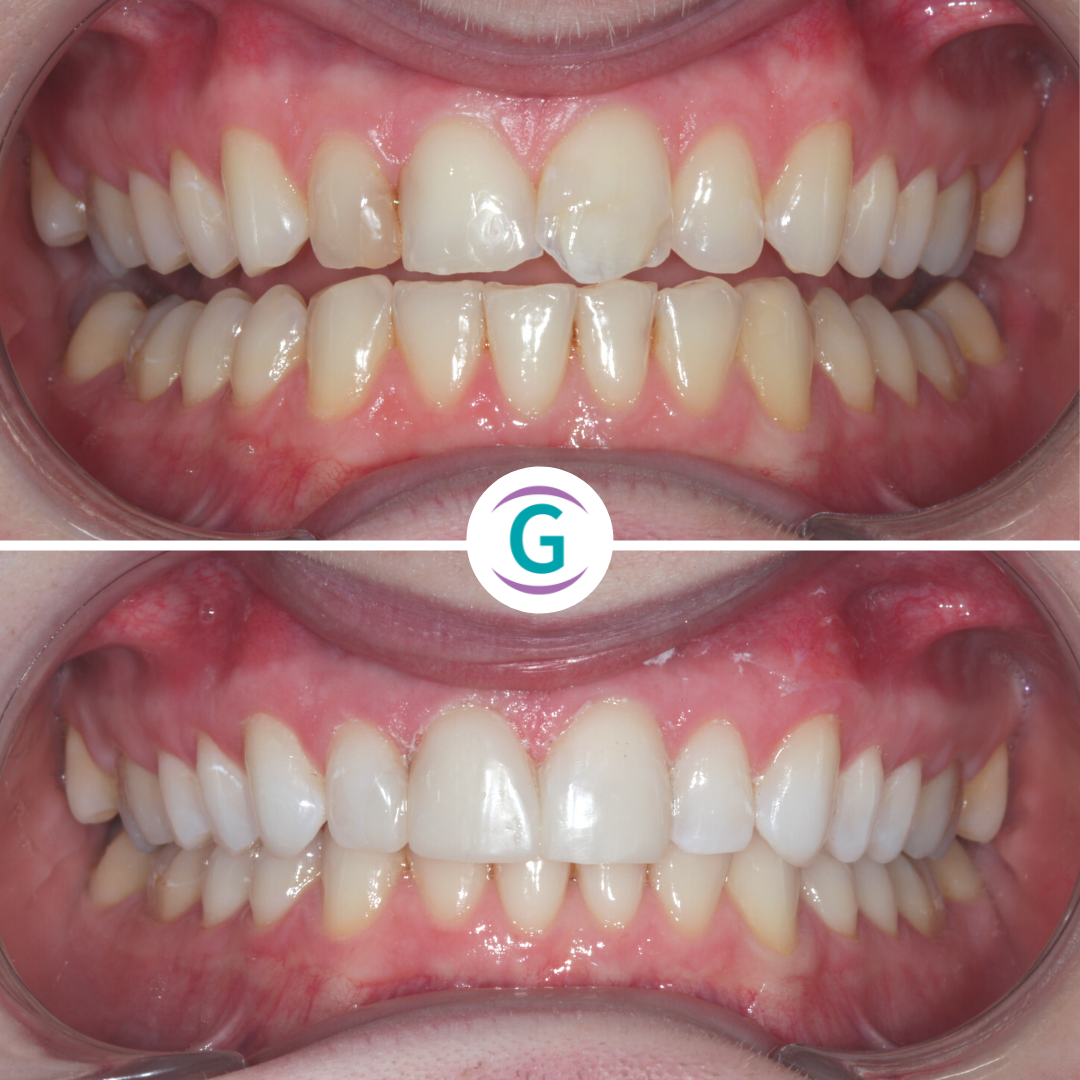 Composite Bonding Treatment