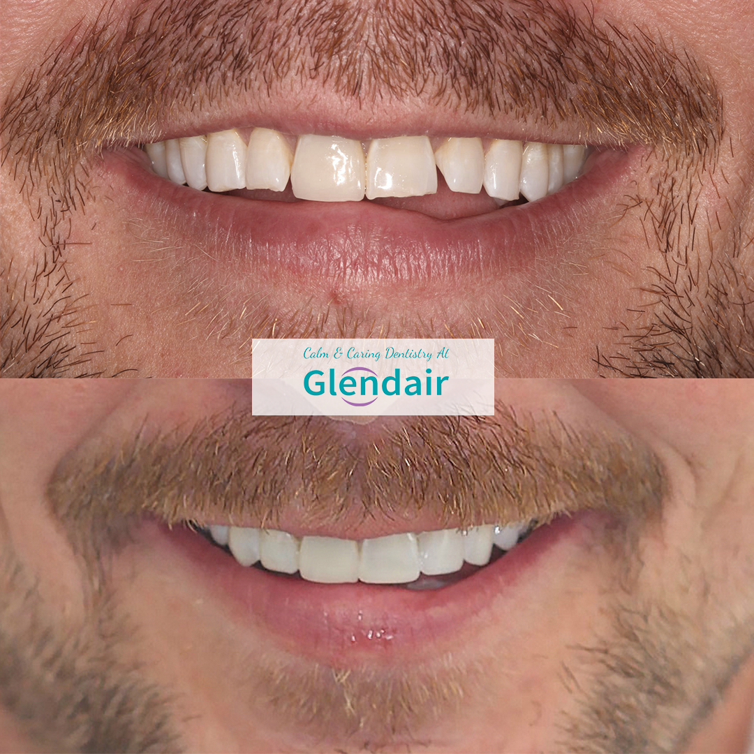 Composite Bonding Treatment