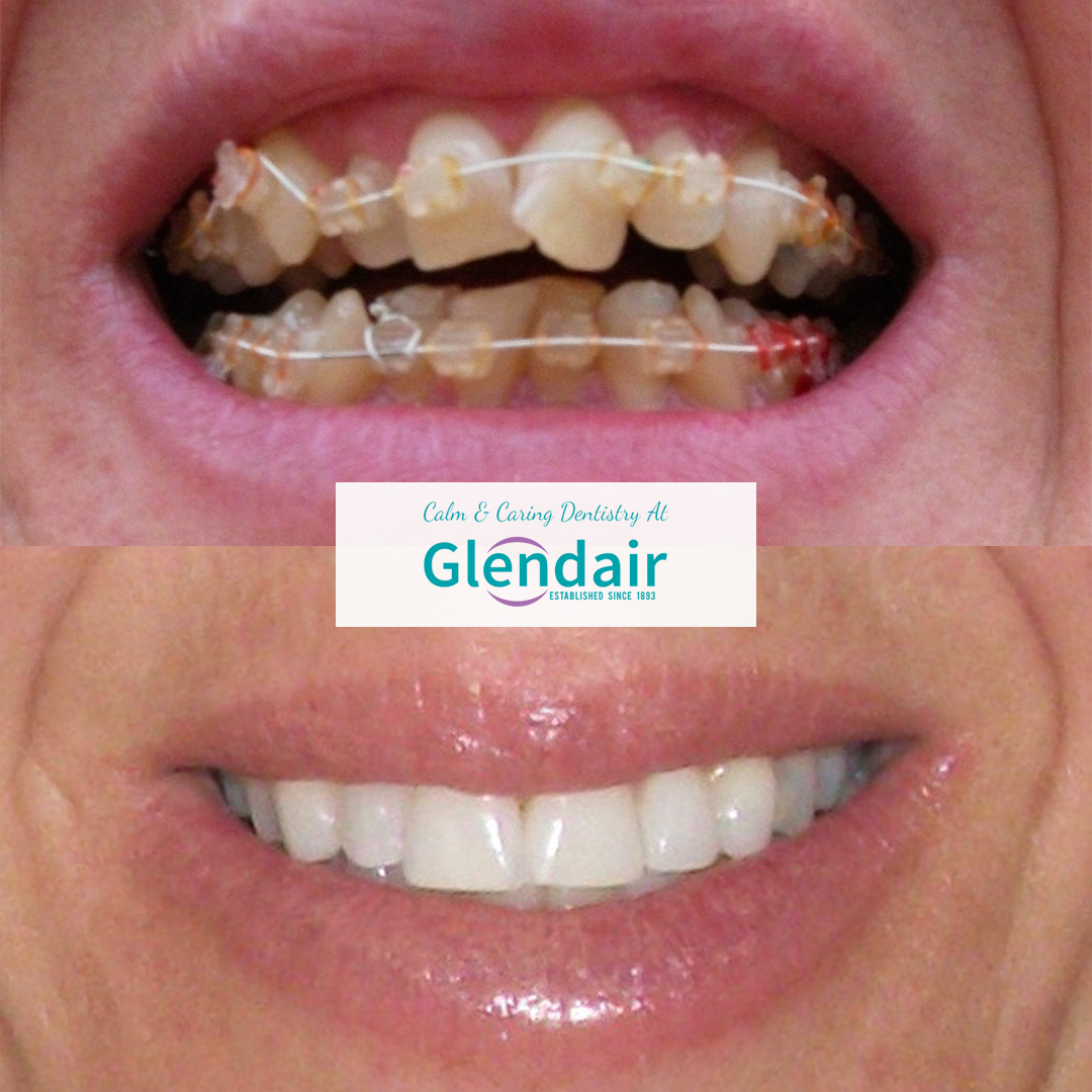 Fixed Braces
