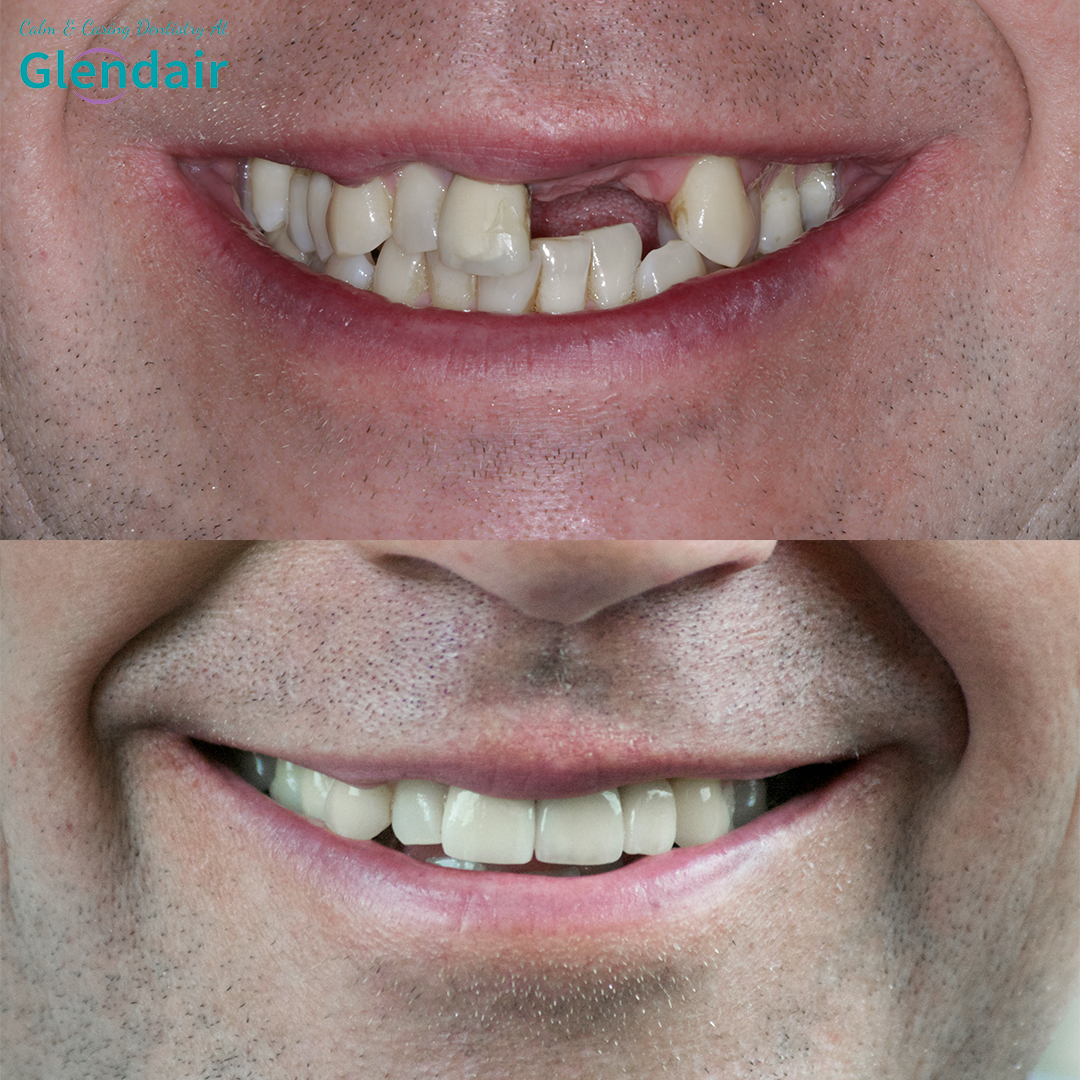 Dental Implants Treatment