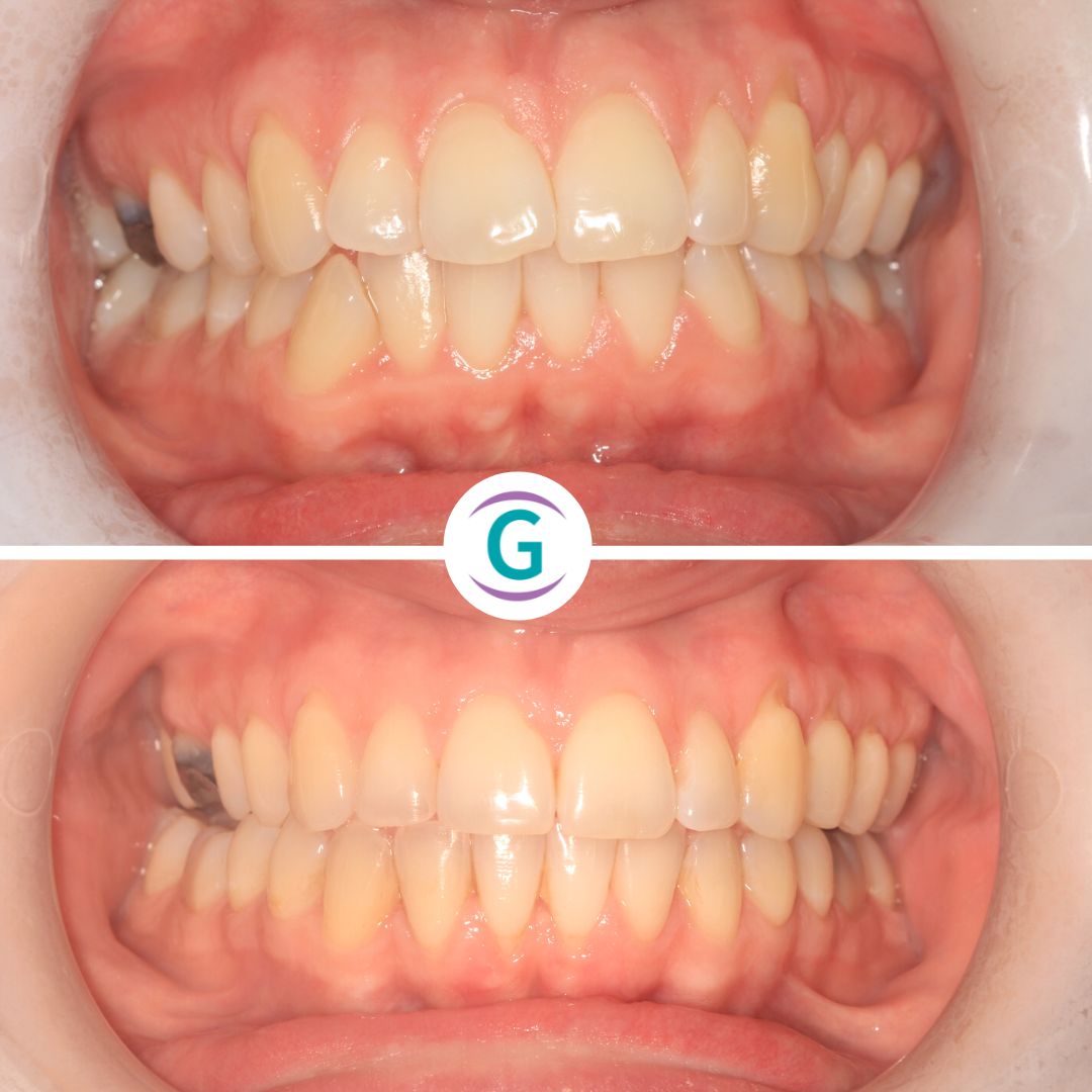 Invisalign Straightening