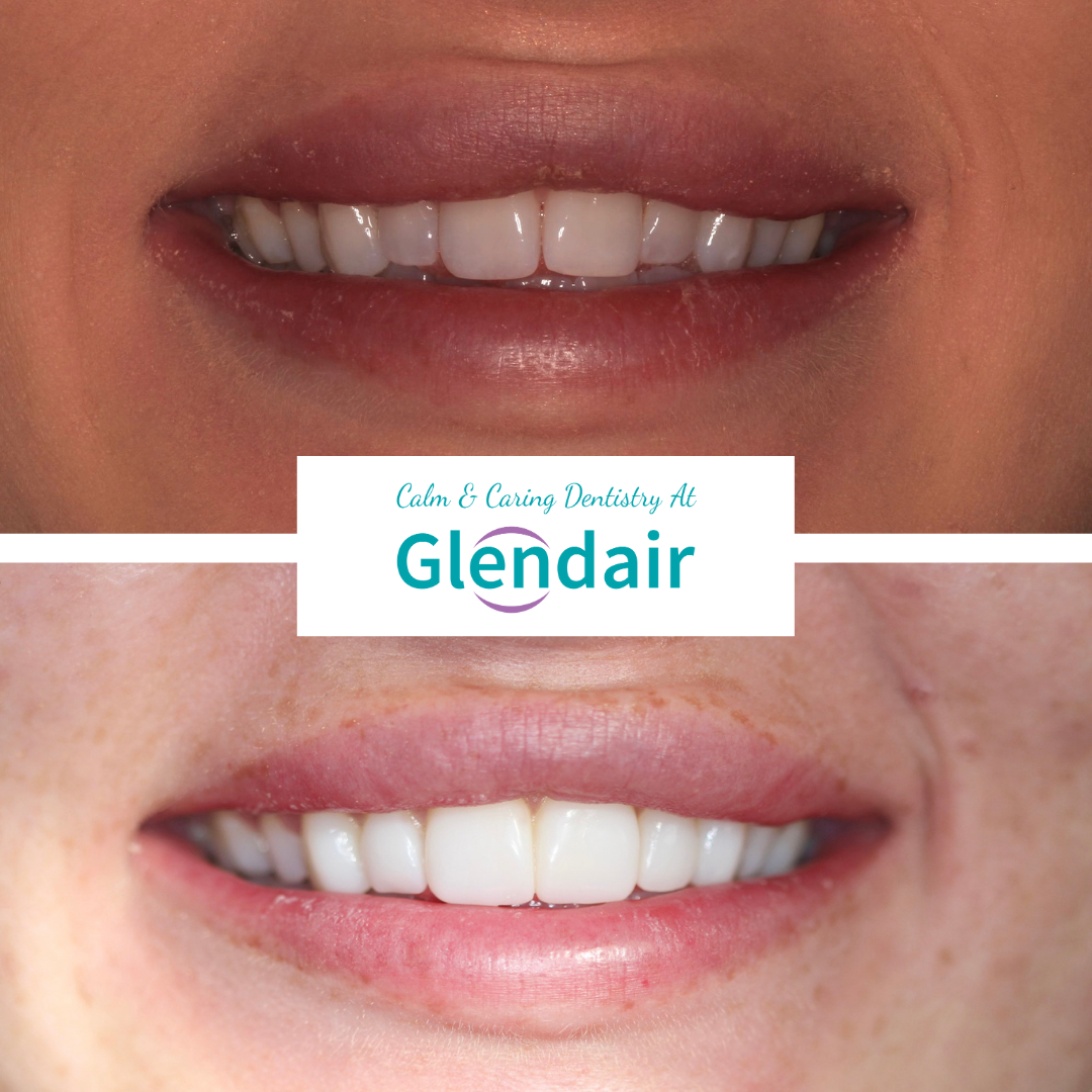 Smile Fast Treatment