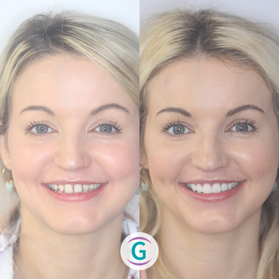 Smile Fast Treatment