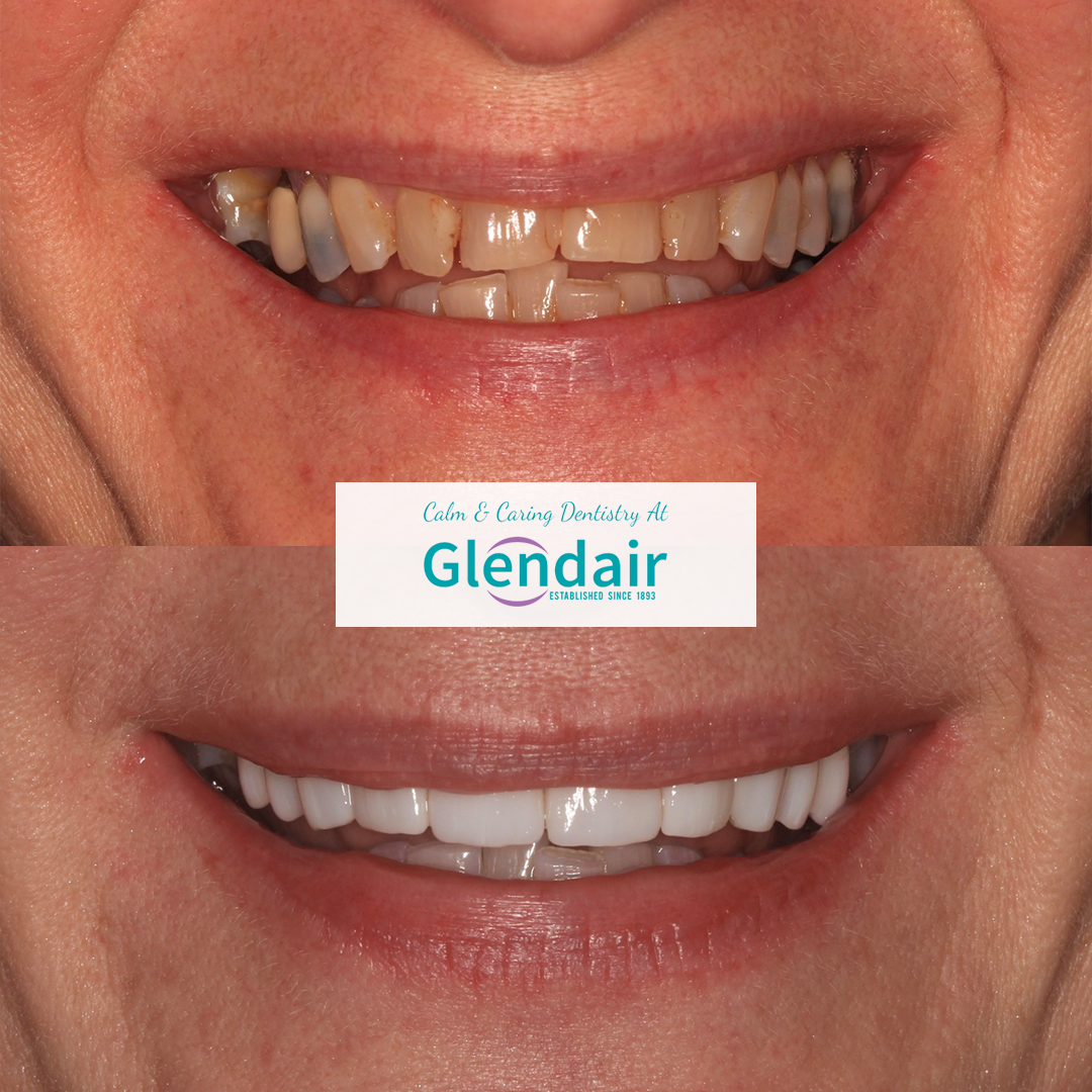 Smile Makeover Treatment