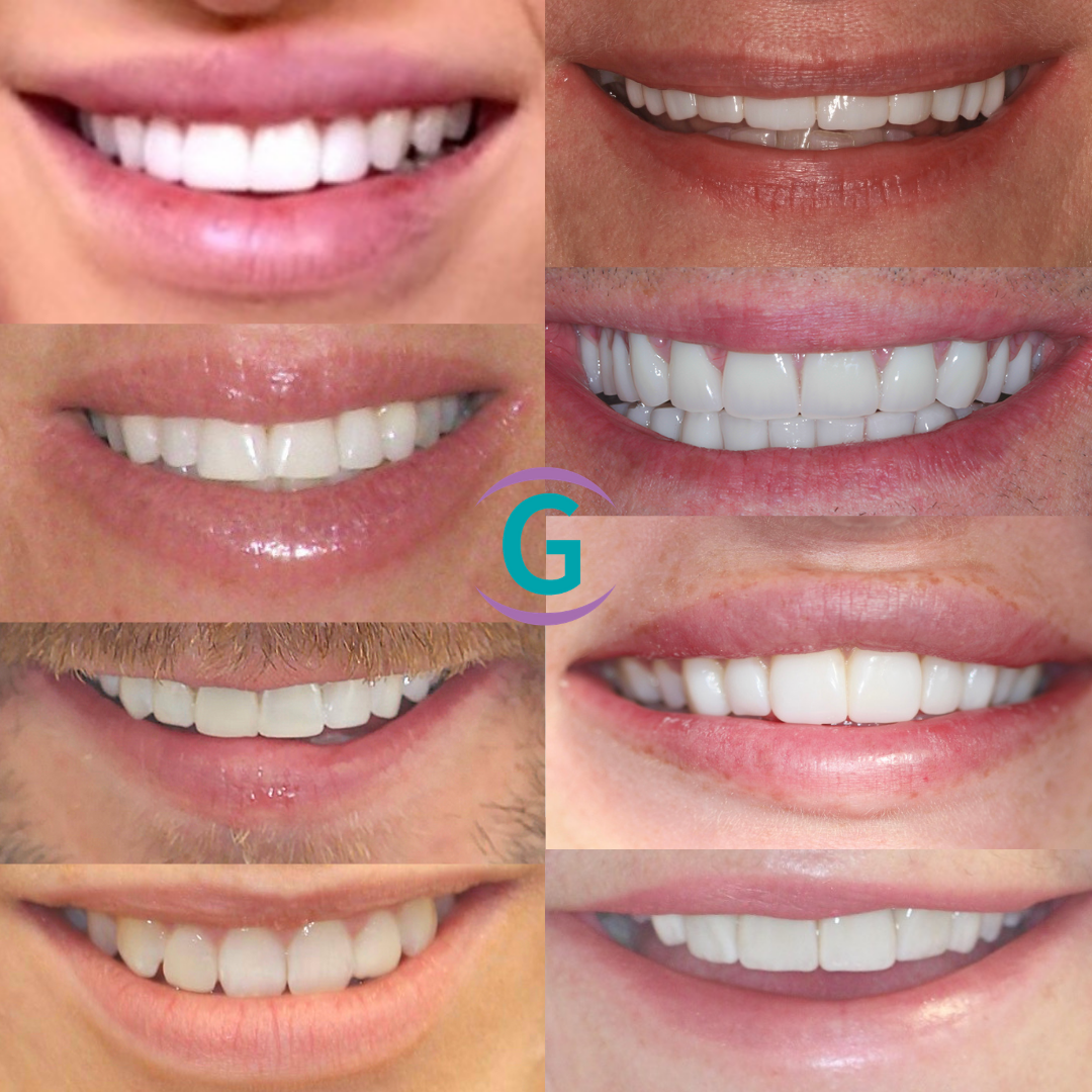 Smile Makeover Treatment