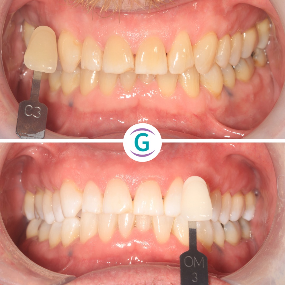 Before and after teeth whitening
