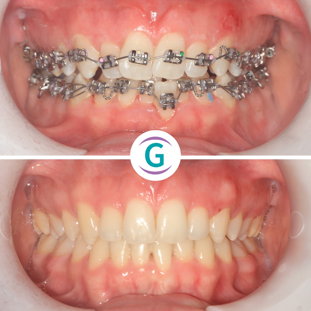 Fixed Braces
