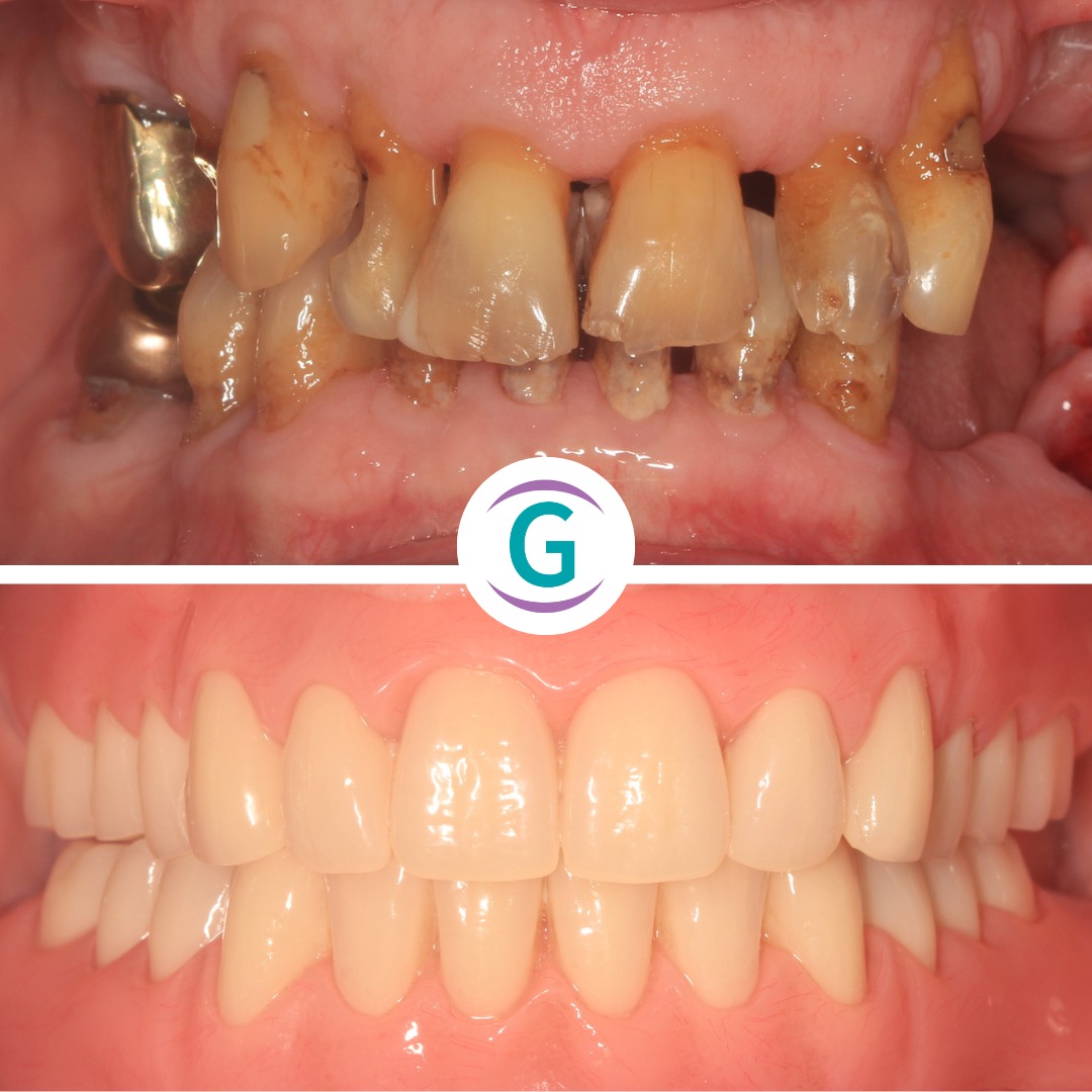 Dental Implants Treatment