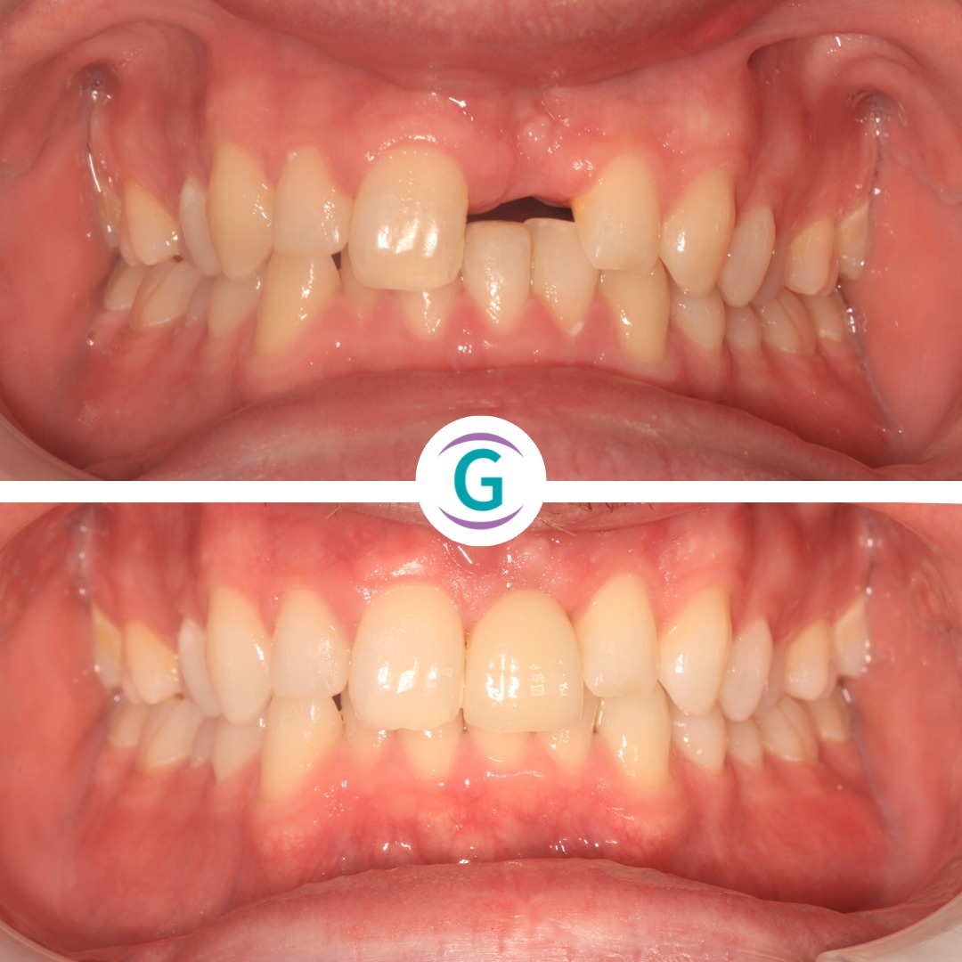 Dental Implants Treatment