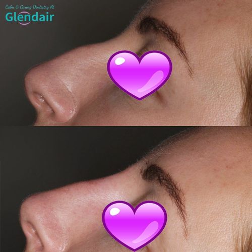 Glendair Dental Face And Beauty Treatments Before And After Beauty Treatment