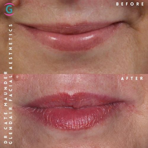Glendair Dental Face And Beauty Treatments Before And After Beauty Treatment