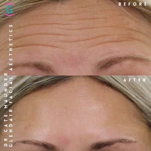 Glendair Dental Face And Beauty Treatments Before And After Beauty Treatment