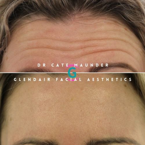 Glendair Dental Face And Beauty Treatments Before And After Beauty Treatment